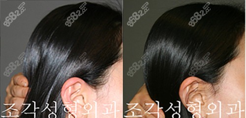 韩国雕刻扁头变圆头整形手术前后对比图