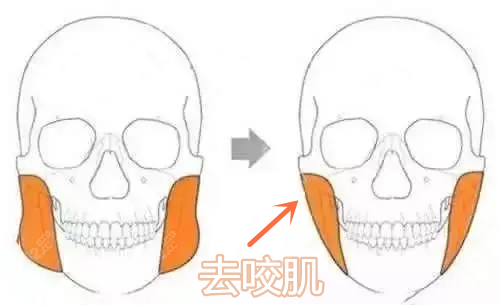 赵绛波做下颌角长曲线截骨+去咬肌