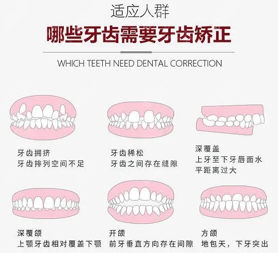 深圳宝安区牙齿矫正价格是多少钱