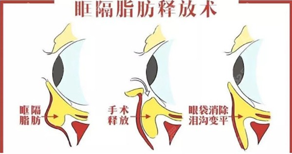 眶隔脂肪释放术