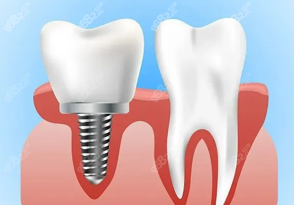 种植牙即拔即种的条件是什么www.8682.cc