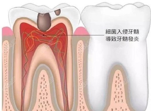 根管治疗和杀神经的区别