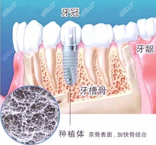 青岛哪里种植牙价格便宜又好