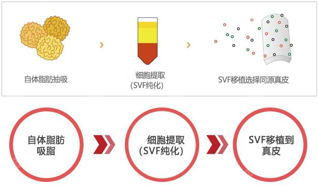 韩国世檀塔男科阴茎镶珠手术过程图示