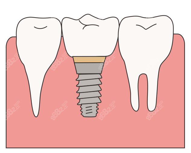 种植牙即拔即种用什么种植体好