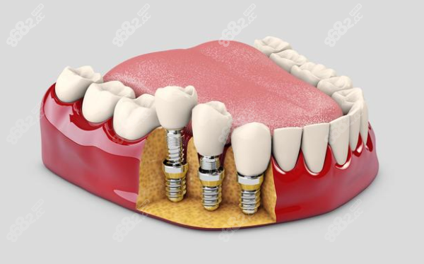 杭州下沙佳尔仕口腔种植牙多少钱一颗