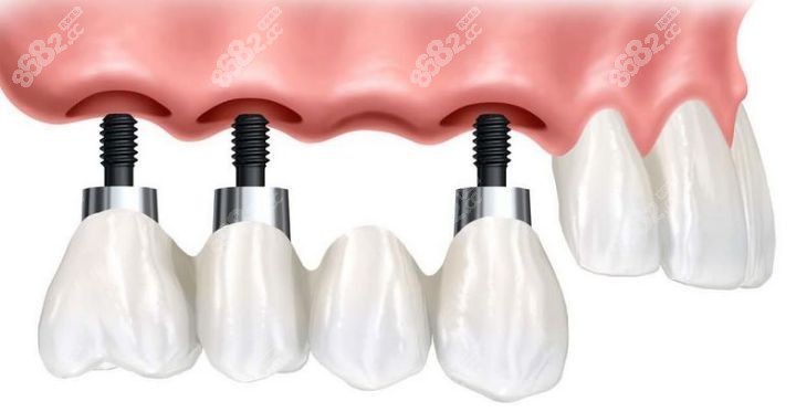 后磨牙确实4颗的正确种植技术
