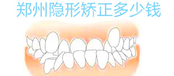 郑州隐形矫正牙齿多少钱