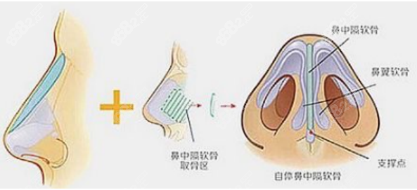 王成毅医生隆鼻怎么样