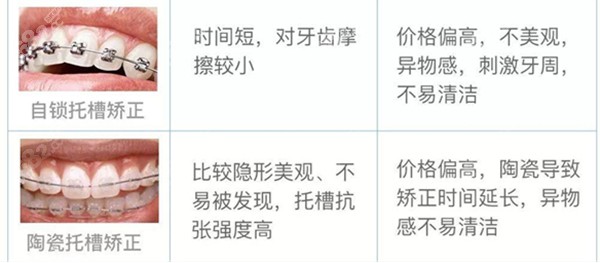 陶瓷半隐形牙套的图