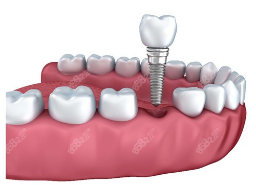 www.8682.cc随州牙博士口腔种植牙怎么样