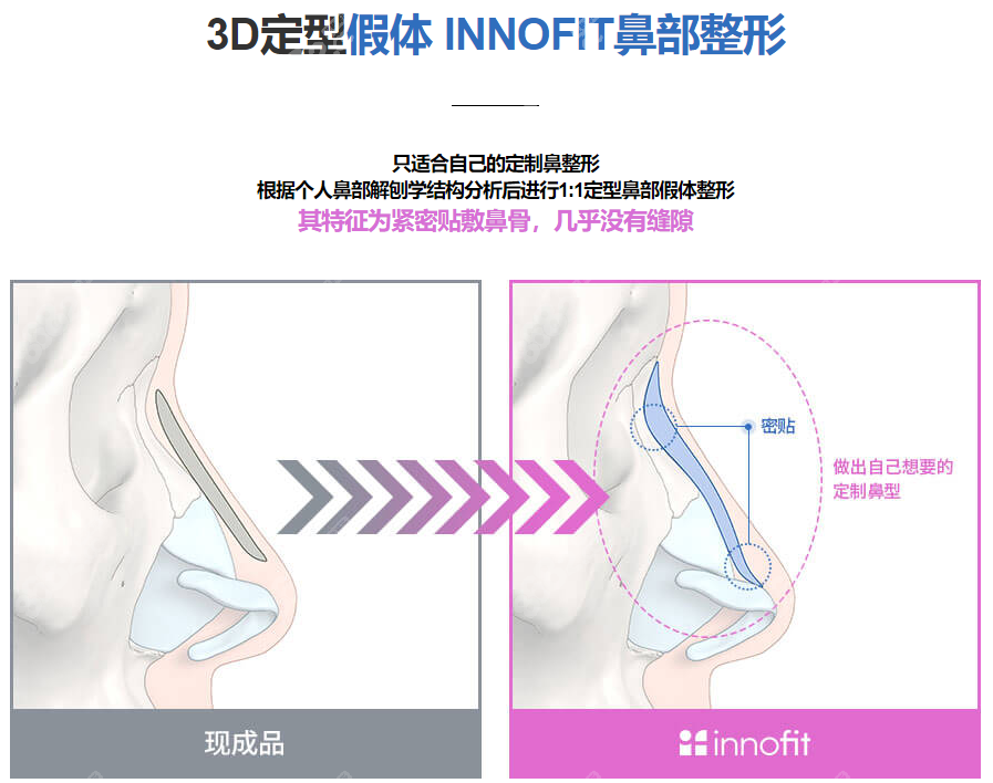 韩国gng整形3D隆鼻技术优势