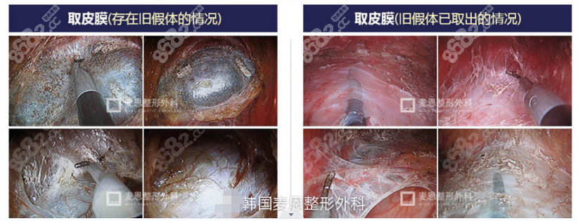 韩国麦恩医院李圣郁做失败胸修复技术好m.8682.cc