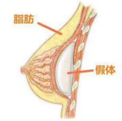 张朝阳医生隆胸