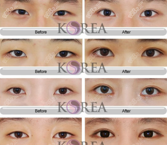 韩国korea整形医院双眼皮实例图
