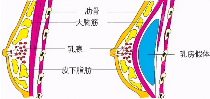 张朝阳医生隆胸怎么样？