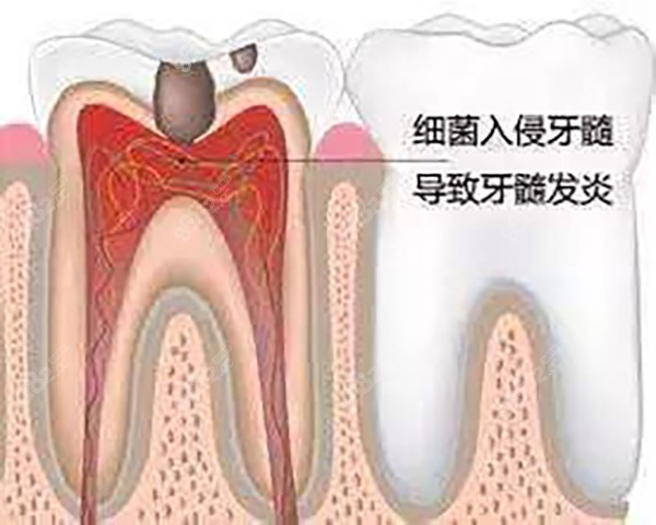 牙髓炎