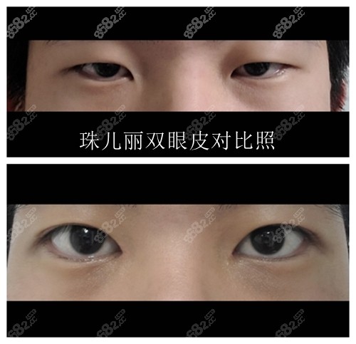 韩国珠儿丽整形外科割双眼皮怎么样