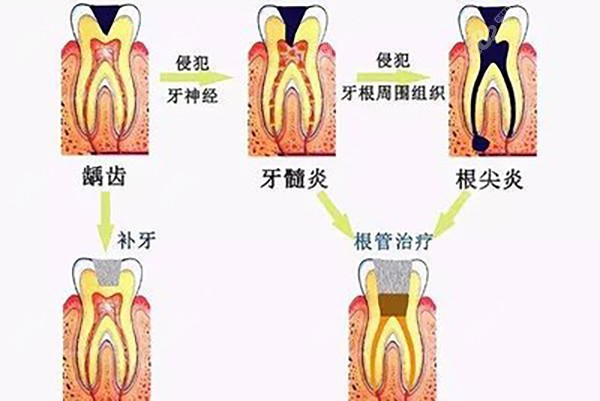 龋坏治疗