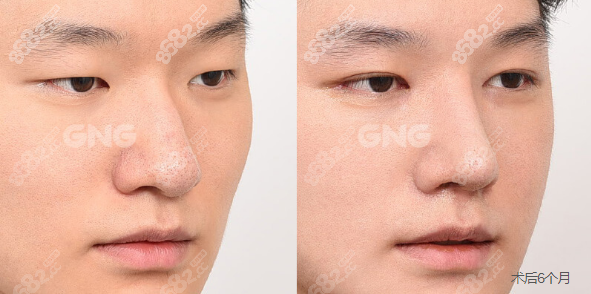 韩国GNG无假体隆鼻鼻综合术后对比图m.8682.cc
