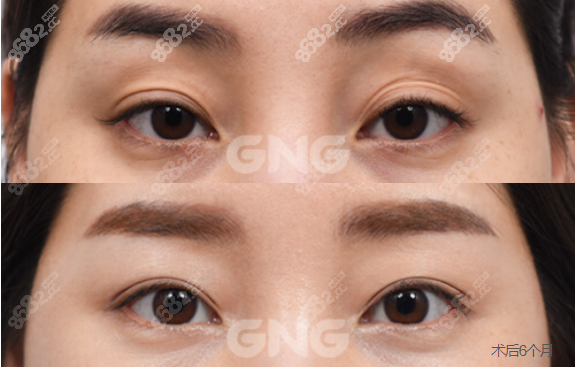 韩国GNG眼修复术后6个月对比图