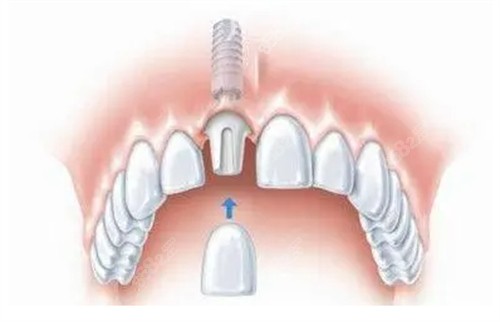 常州曙光口腔种植牙做的好