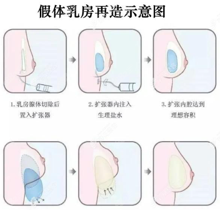 假体乳房重建手术过程图8682.cc