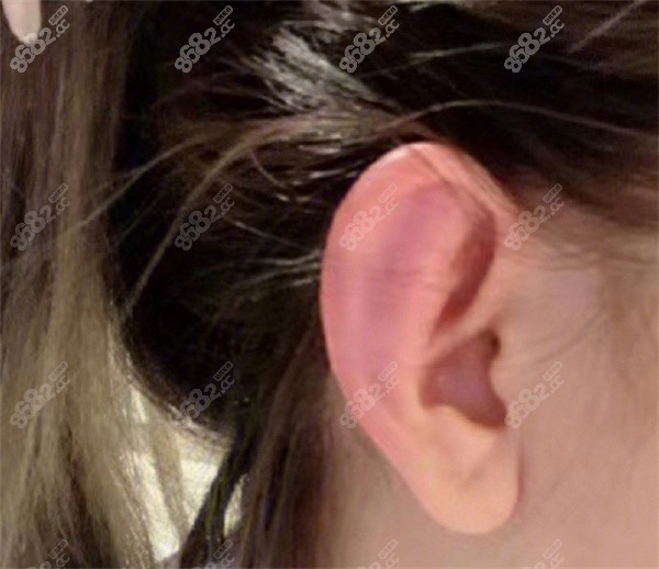玻尿酸精灵耳朵怎么整形？