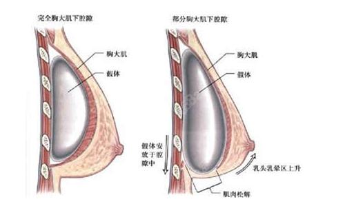 中国隆胸失败修复好的医院排名有谁