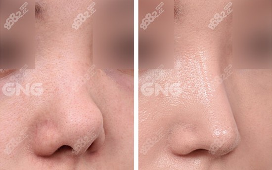 韩国GNG挛缩鼻修复术后对比图