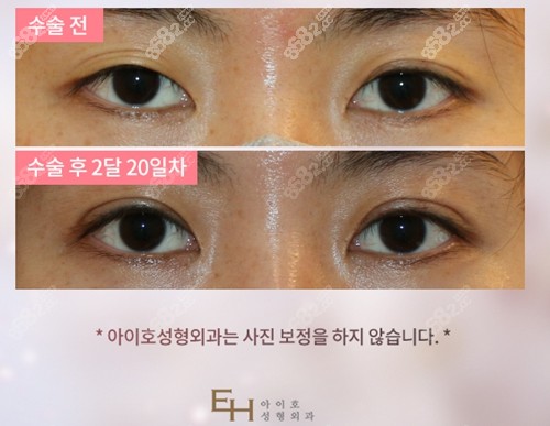 韩国爱护整形医院割双眼皮实例