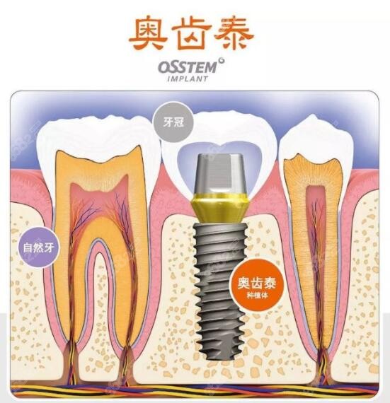 适合门牙种植的韩国奥齿泰种植品牌