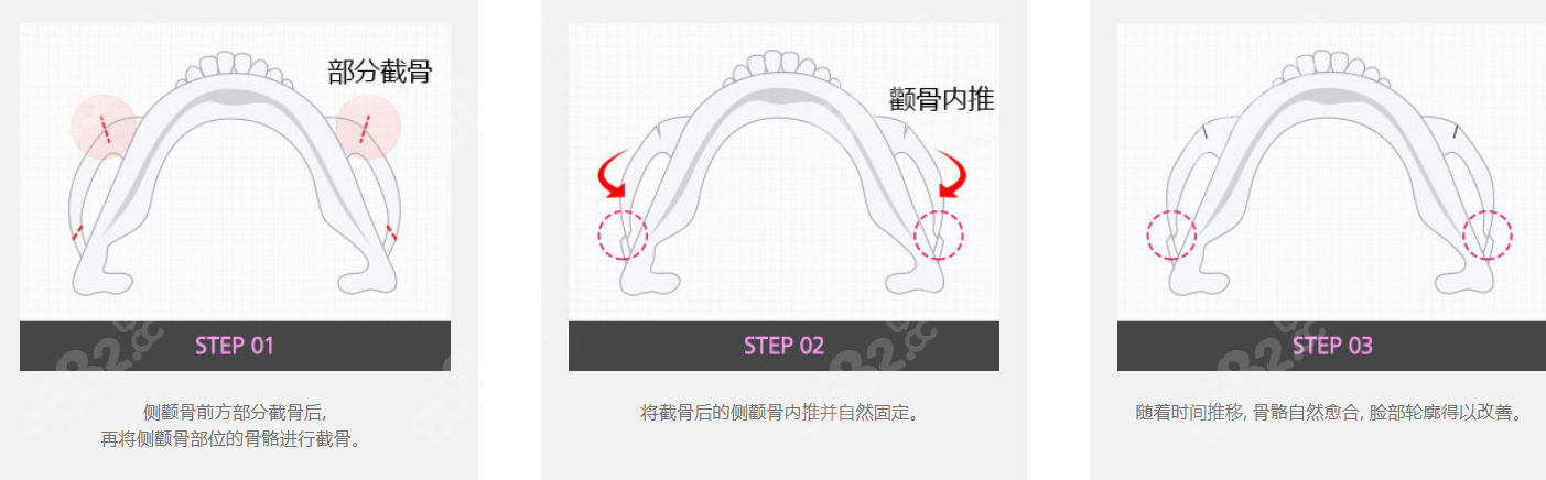 韩国格瑞丝噢爱美医院颧骨磨骨过程和步骤图片