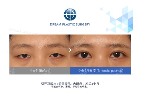 韩国梦想整形外科医院眼部整形价格