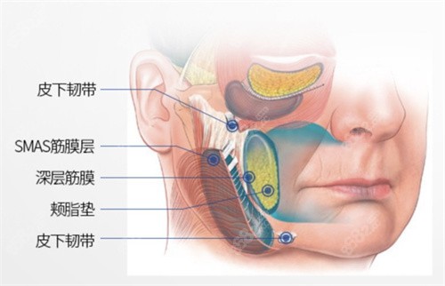 多层复原面部提拉手术是什么？