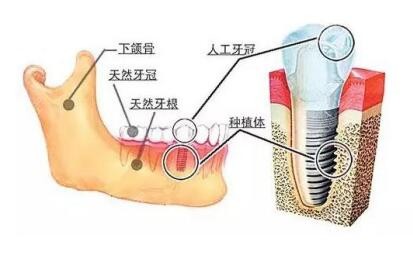 如何避免种植牙踩坑