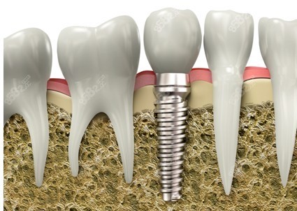 种植牙