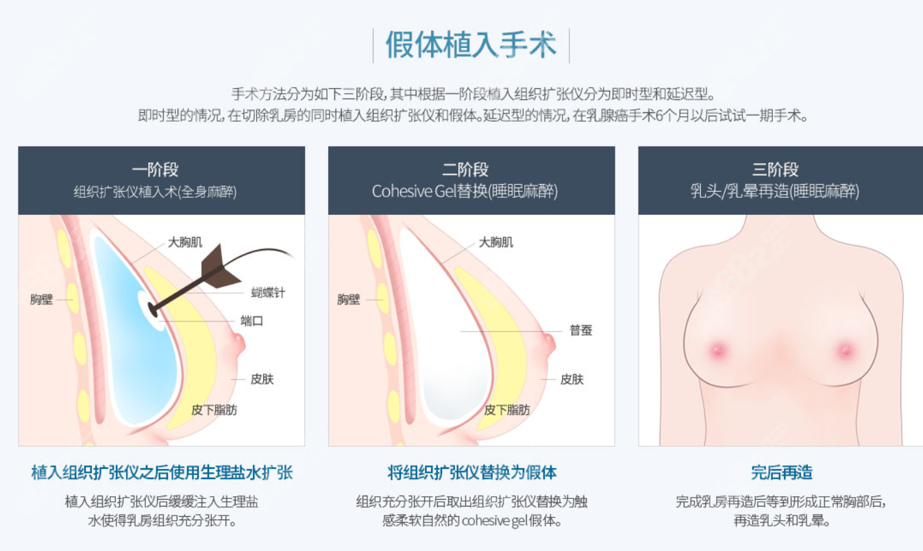 中国韩国假体植入乳房重建手术过程图片