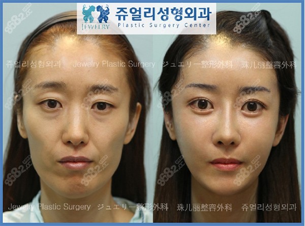 韩国珠儿丽医院面部手术病例反馈