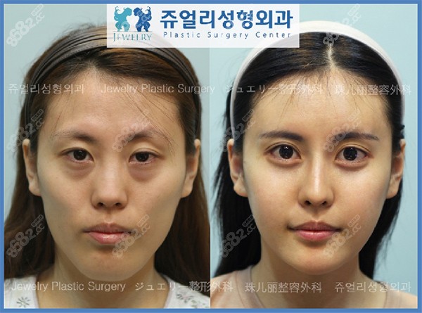 韩国珠儿丽医院面部轮廓手术病例反馈