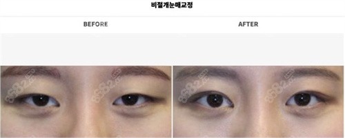 韩国大眼睛整形外科非切开提肌矫正照片二