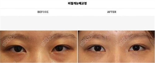 韩国大眼睛整形外科非切开提肌矫正照片一