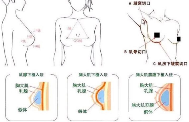 韩国md整形医院李相达院长做胸部修复技术好又自然