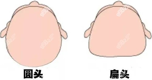 头部整形有哪些方法？