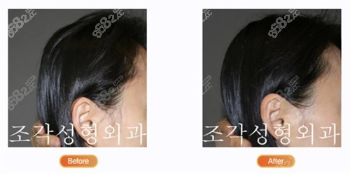 韩国雕刻医院后脑勺填充照片