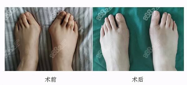 拇外翻手术过程