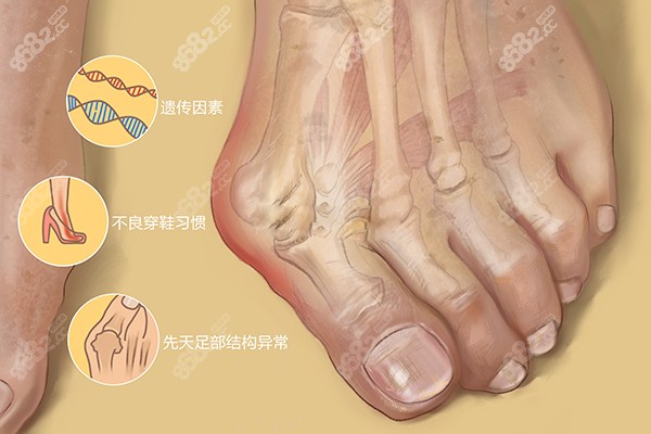 拇外翻是什么原因引起的