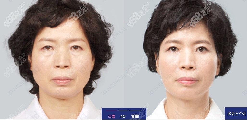 韩国专门做面部提升的医院面部提升实例分享8682.cc