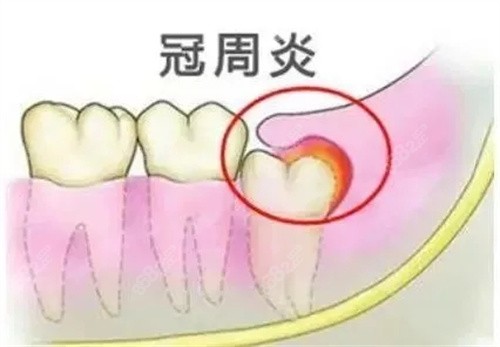 急性冠周炎