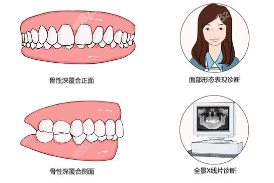 成人骨性深覆合矫正难度大